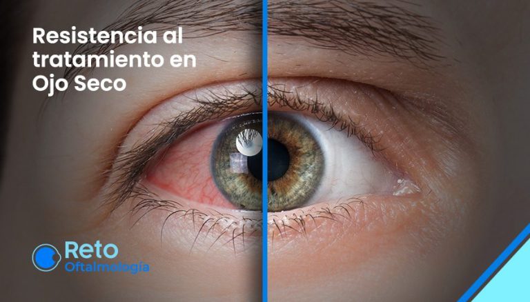 Resistencia al tratamiento en Ojo Seco