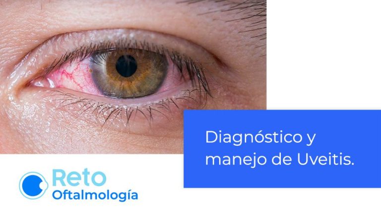 Determinando un tratamiento para uveítis 