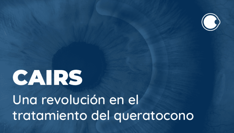 Segmentos de anillos intraestromales alogénicos corneales (CAIRS): Una revolución en el tratamiento del queratocono