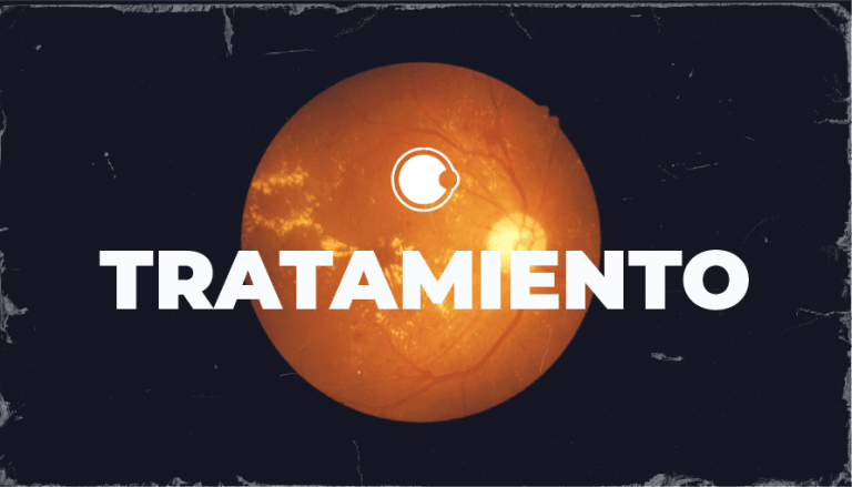 ¿Qué es lo nuevo en el tratamiento para atrofia geográfica?