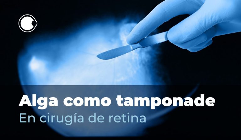 Alga como tamponade en cirugía de retina