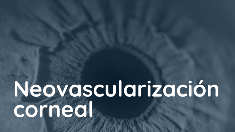 Neovascularización corneal: una nueva esperanza con quimioembolización intravascular